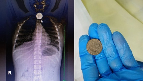 На Чернігівщині лікарі витягли зі стравоходу дитини велику монетуНа Чернігівщині лікарі витягли зі стравоходу дитини велику монету